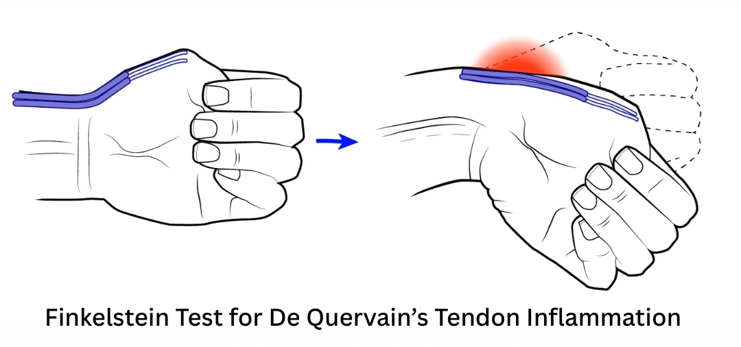 Finkelstein test demonstration used to clinically diagnose De Quervain tenosynovitis at the thumb side of the wrist
