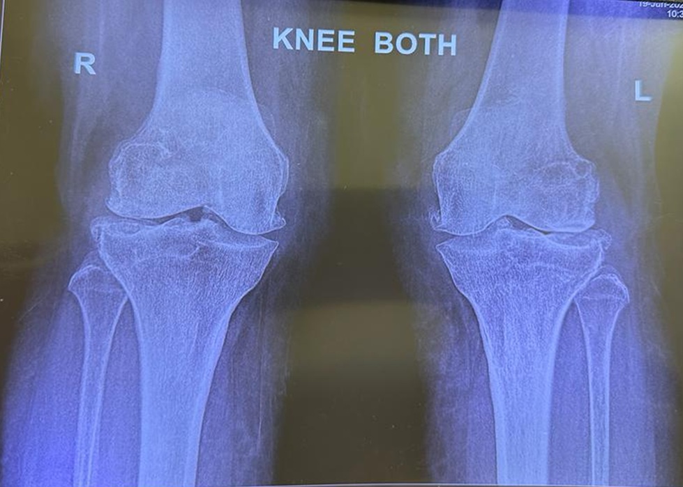 Standing X ray of both knees showing advanced arthritis before knee replacement at OrthoCure Thirumullaivoyal