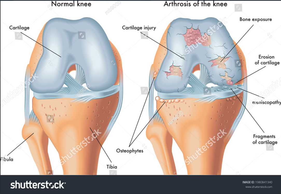 Normal vs Arthritic Knee